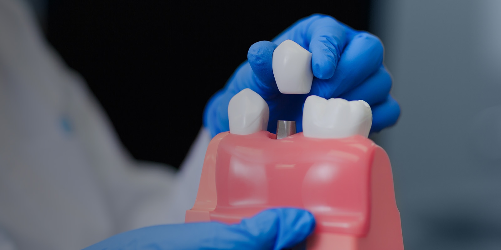 A dentist placing a dental crown on a tooth model.