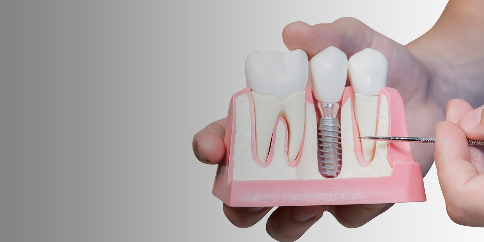 A dental model showing a tooth implant.