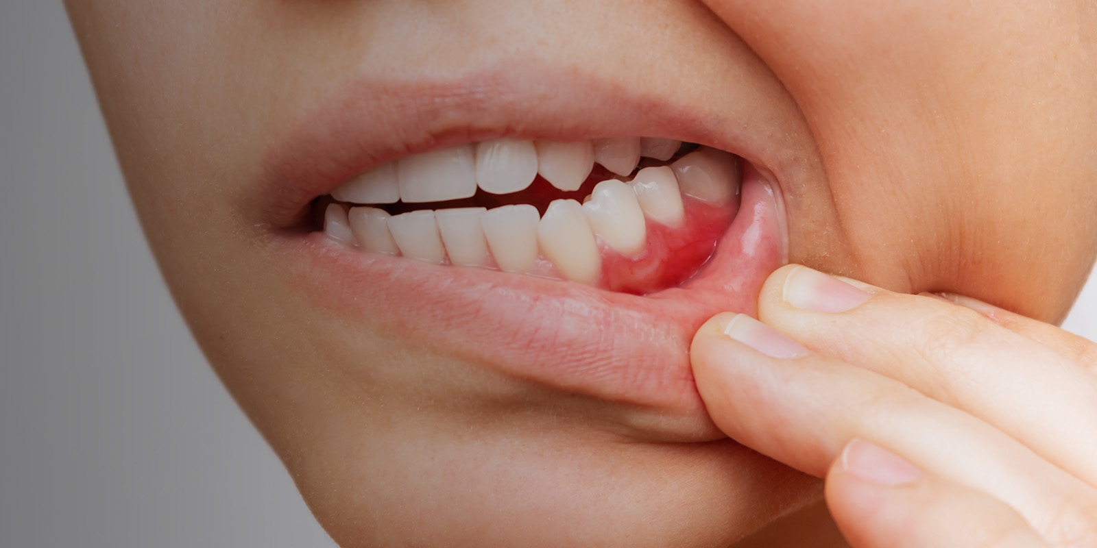 A woman pulling down her lip to show irritated gums.
